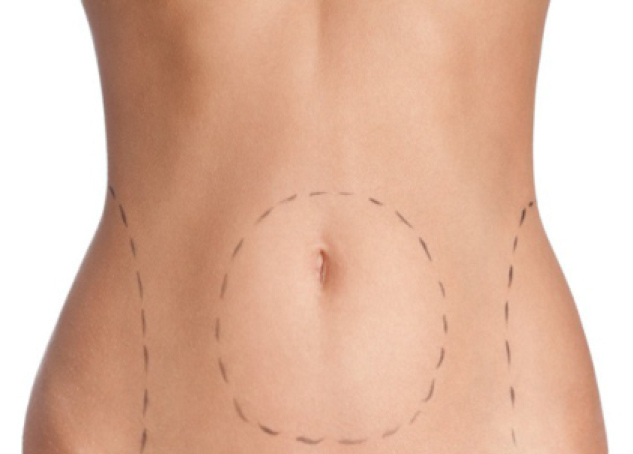Abdominoplastia
