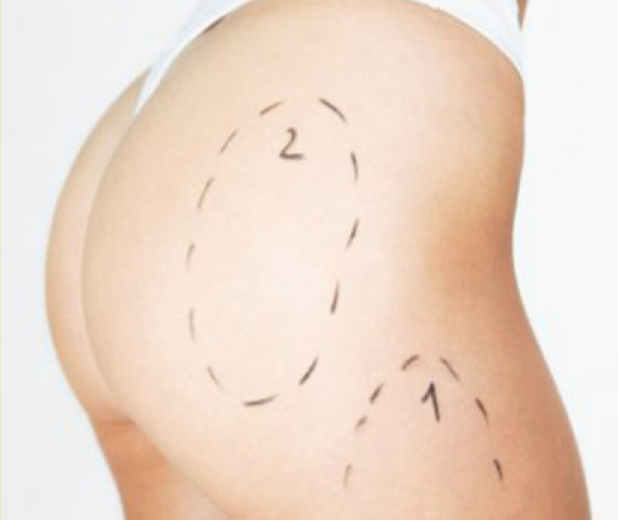 Lipoaspiração
